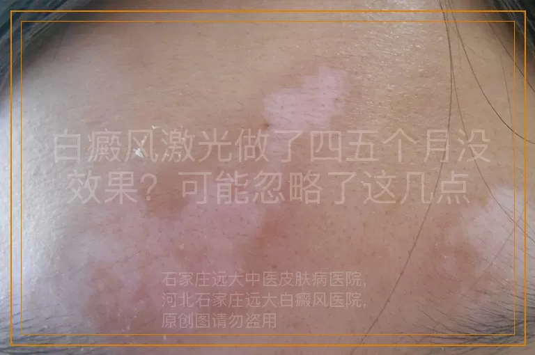 白癜风激光做了四五个月没效果？可能忽略了这几点