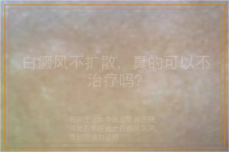 白癜风不扩散，真的可以不治疗吗？