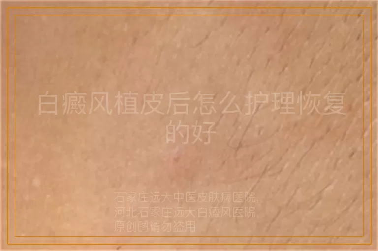 白癜风植皮后怎么护理恢复的好