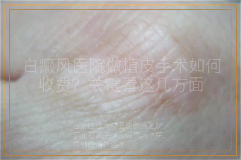 白癜风医院做植皮手术如何收费？关键看这几方面