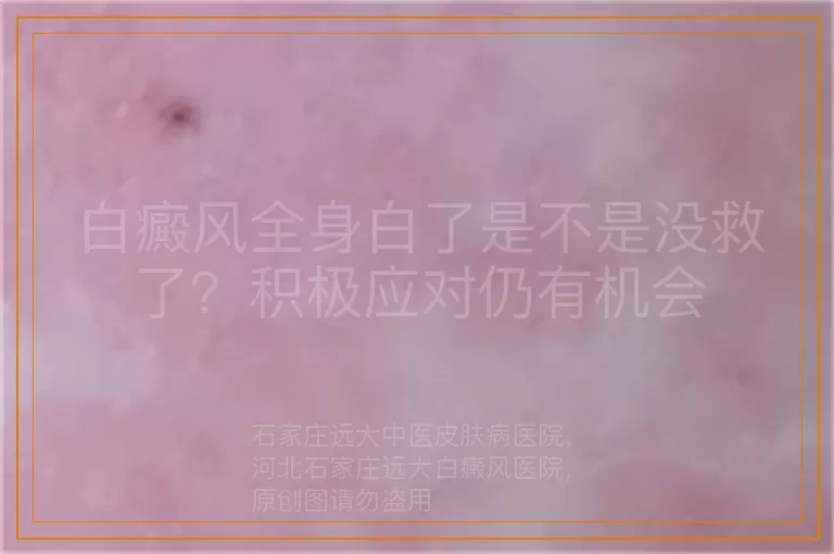 白癜风全身白了是不是没救了？积极应对仍有机会