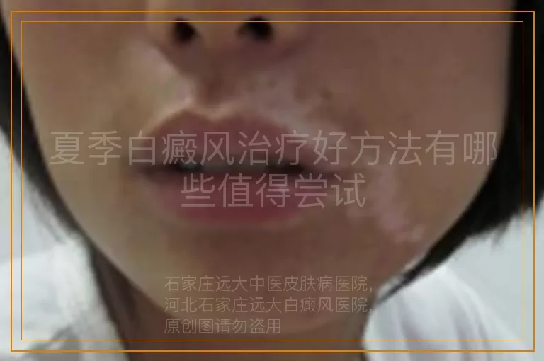 夏季白癜风治疗好方法有哪些值得尝试