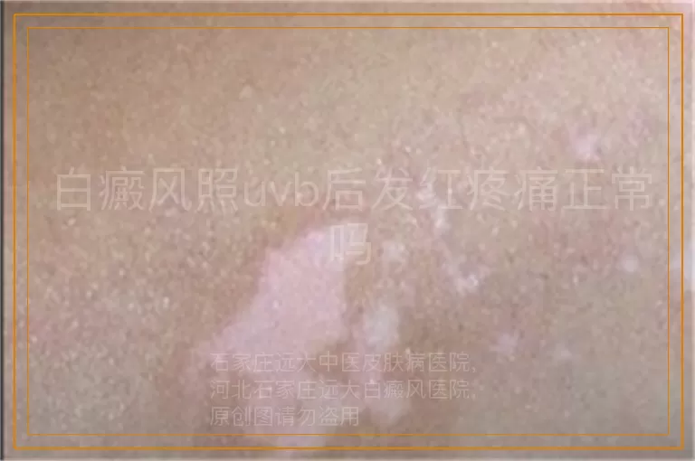 白癜风照uvb后发红疼痛正常吗
