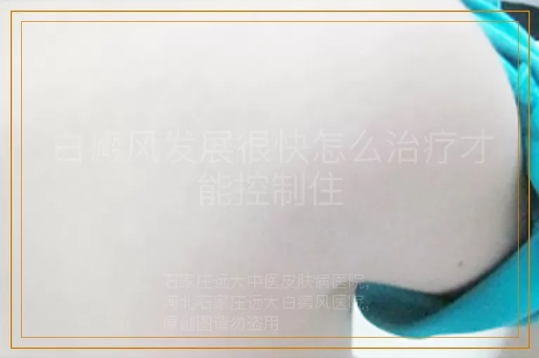 白癜风发展很快怎么治疗才能控制住