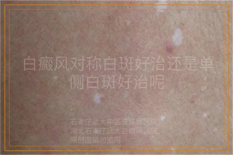 白癜风对称白斑好治还是单侧白斑好治呢