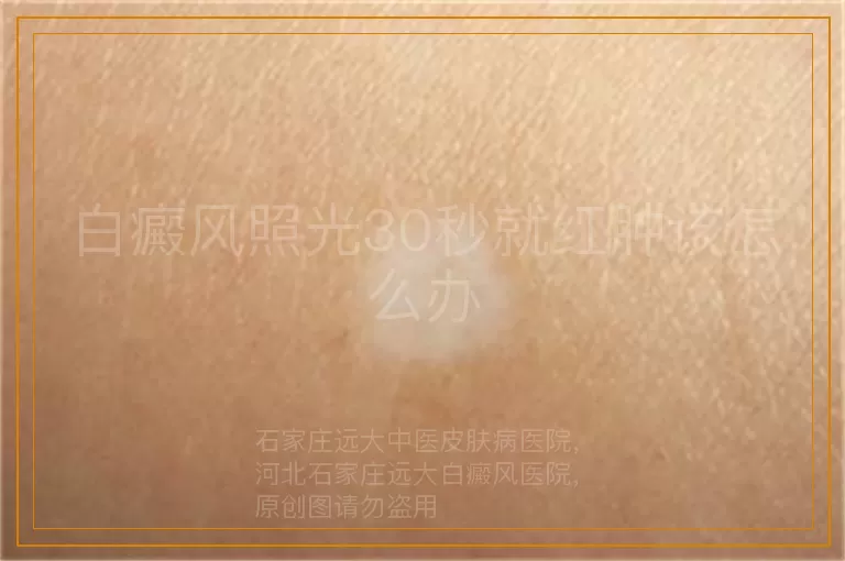 白癜风照光30秒就红肿该怎么办