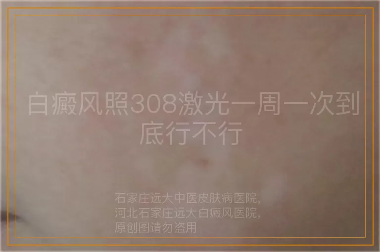 白癜风照308激光一周一次到底行不行