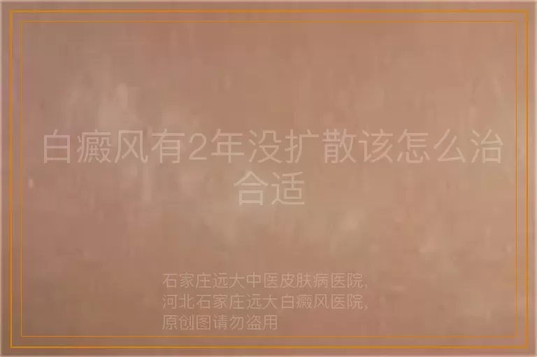 白癜风有2年没扩散该怎么治合适