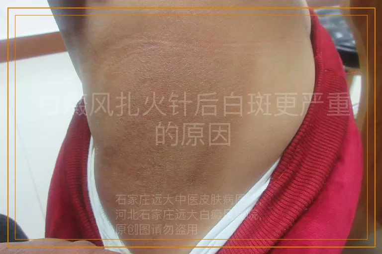 白癜风扎火针后白斑更严重的原因