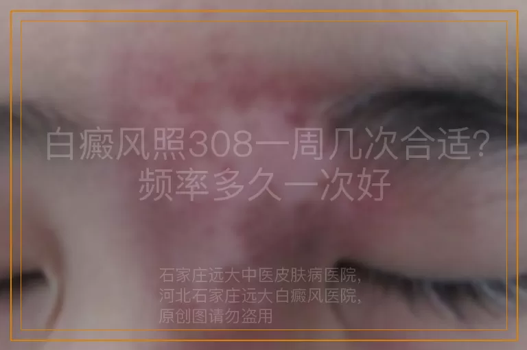 白癜风照308一周几次合适？频率多久一次好