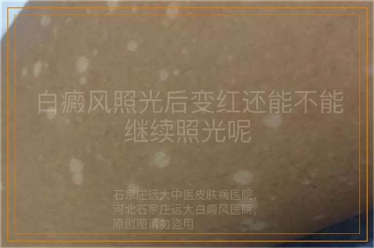 白癜风照光后变红还能不能继续照光呢