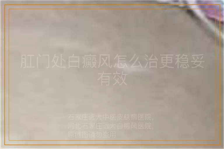 肛门处白癜风怎么治更稳妥有效