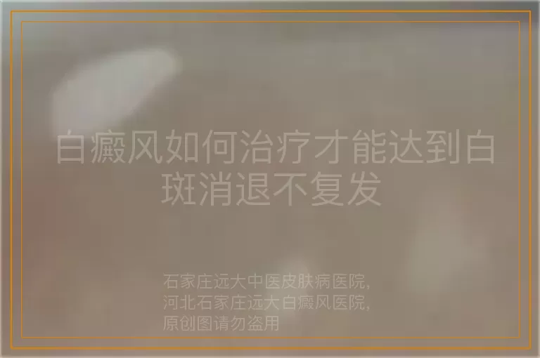 白癜风如何治疗才能达到白斑消退不复发