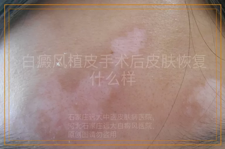 白癜风植皮手术后皮肤恢复什么样