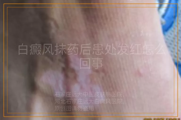白癜风抹药后患处发红怎么回事