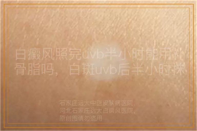 白癜风照完uvb半小时能用补骨脂吗，白斑uvb后半小时抹补骨脂行吗，白癜风uvb照射后半小时擦补骨脂可以吗