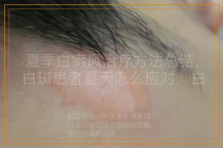 夏季白癜风治疗方法总结，白斑患者夏天怎么应对，白癜风夏季护理治疗要点