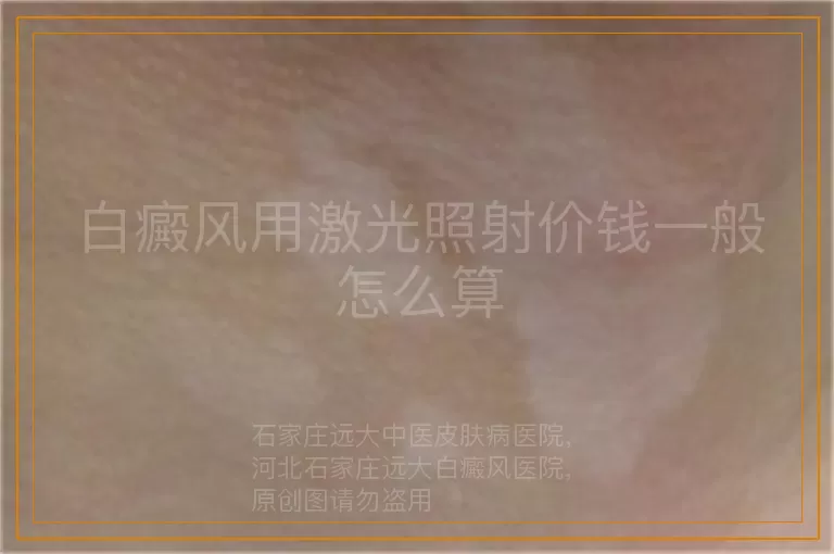 白癜风用激光照射价钱一般怎么算