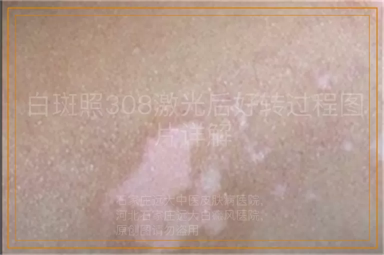 白斑照308激光后好转过程图片详解