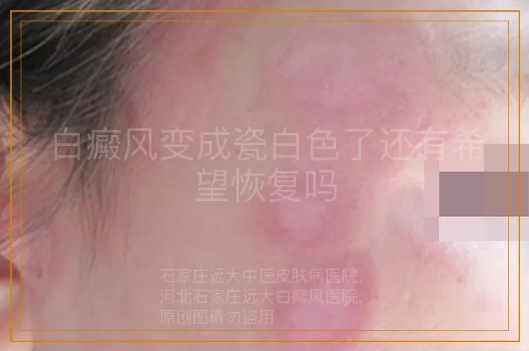 白癜风变成瓷白色了还有希望恢复吗
