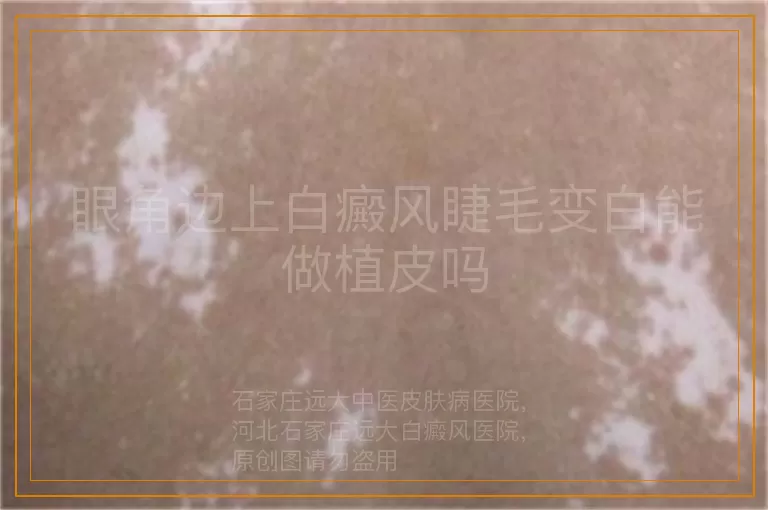 眼角边上白癜风睫毛变白能做植皮吗
