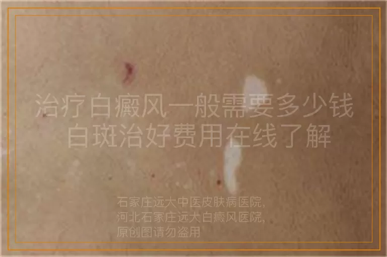 治疗白癜风一般需要多少钱 白斑治好费用在线了解