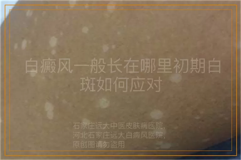 白癜风一般长在哪里初期白斑如何应对