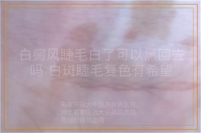 白癜风睫毛白了可以黑回去吗 白斑睫毛复色有希望