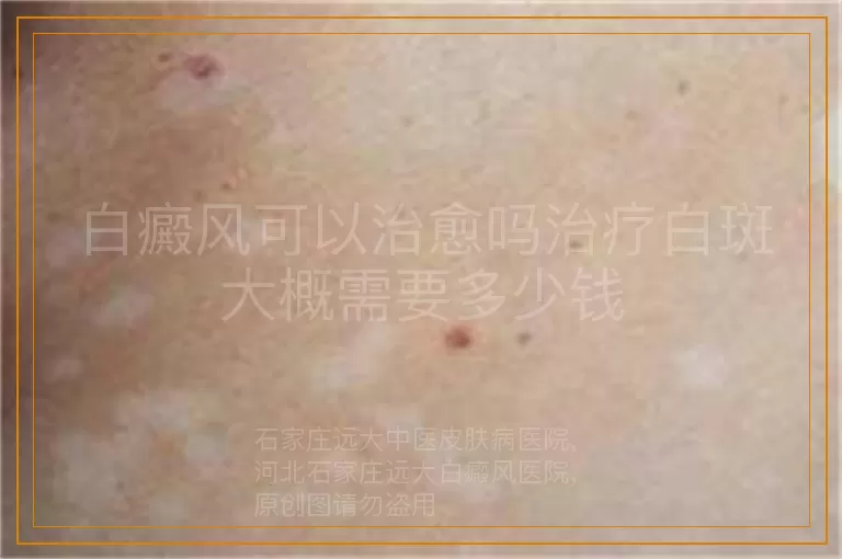 白癜风可以治愈吗治疗白斑大概需要多少钱
