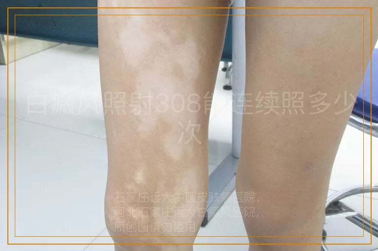 白癜风照射308能连续照多少次