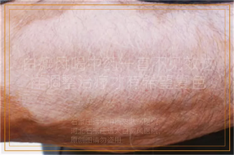 白癜风喝中药一直不见效这样调整治疗才有希望复色