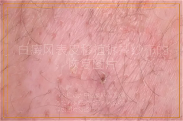 白癜风表皮移植拆掉纱布的恢复图片