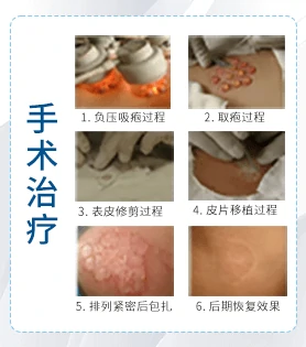 双腿白癜风