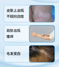 双腿白癜风
