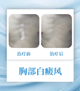 胸部白癜风