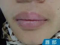 唇部皮肤白癜风白斑图