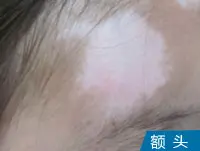 额头皮肤白癜风白斑图