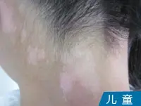 儿童颈部皮肤白斑白癜风图