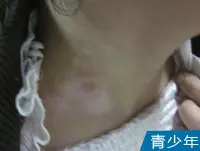 青少年颈部皮肤白斑白癜风图