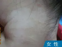 女性颈部皮肤白斑白癜风图