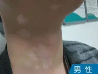 男性颈部皮肤白斑白癜风图