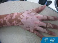 手指皮肤白癜风白斑图