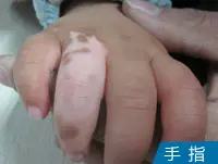 手指头皮肤白癜风白斑图