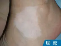 脚部皮肤白癜风白斑图
