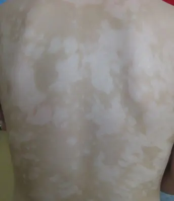 背部皮肤白癜风白斑图