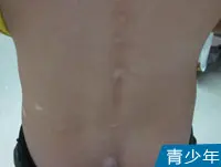 青少年背部皮肤白癜风白斑图