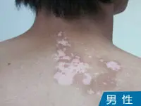 男性背部皮肤白癜风白斑图
