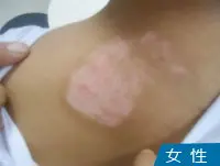 女性背部皮肤白癜风白斑图