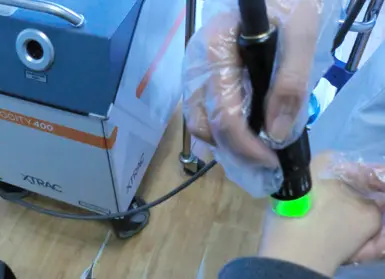 中美308nm准分子激光治白癜风